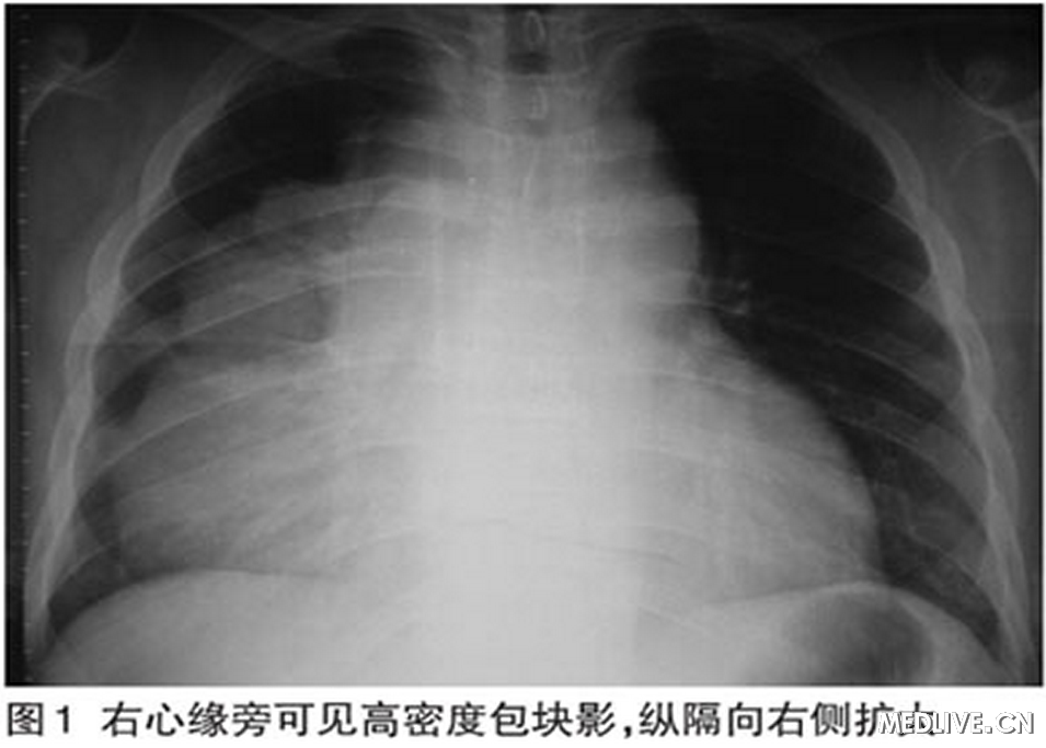 B细胞淋巴瘤