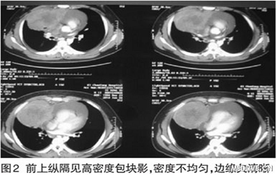 B细胞淋巴瘤