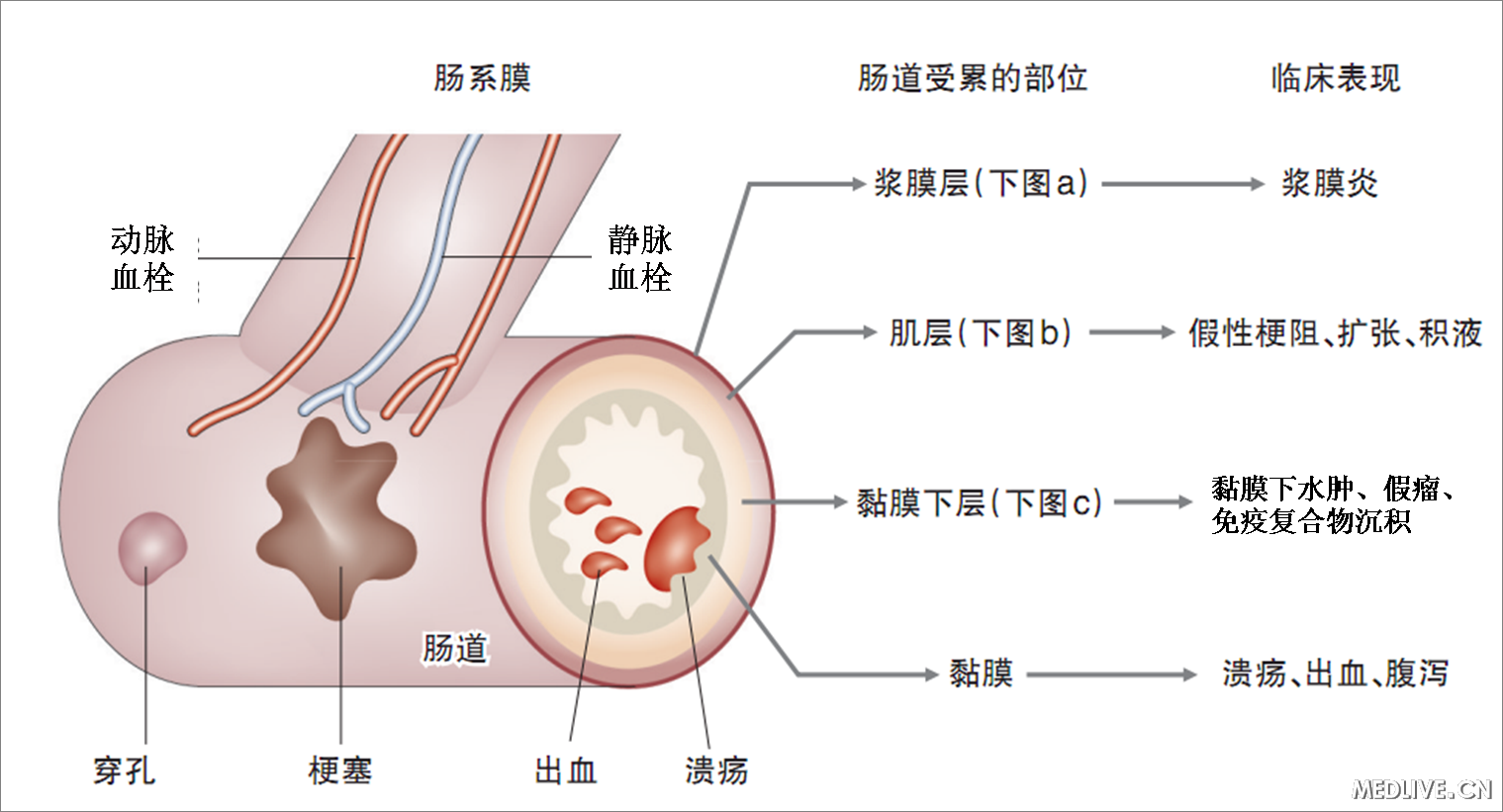在病理上，SLE可累及肠道的动静脉血管、肠壁的浆膜层、肌层、黏膜下层及黏膜层，导致血管血栓或梗死、肠壁的溃疡、出血及穿孔