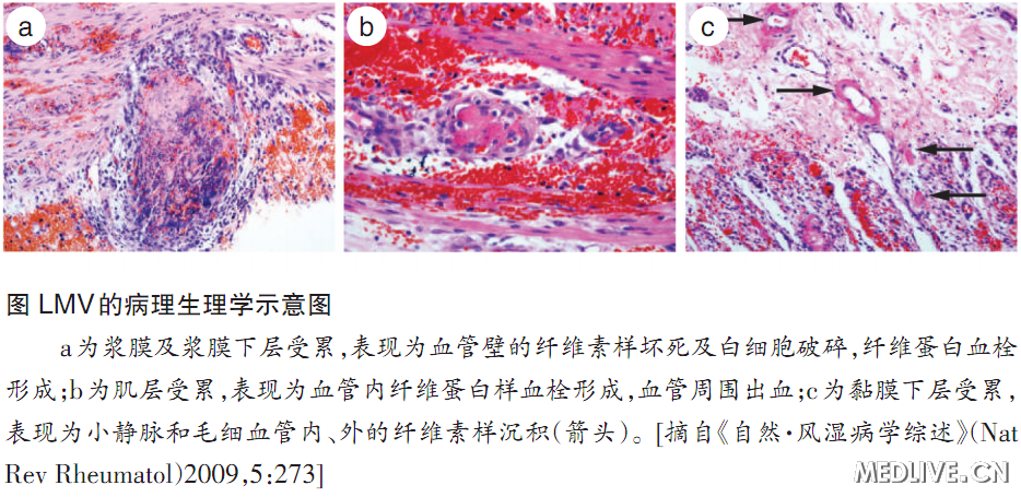 LMV病理生理学示意图