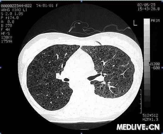 肺淋巴管肌瘤病 气胸 乳糜胸