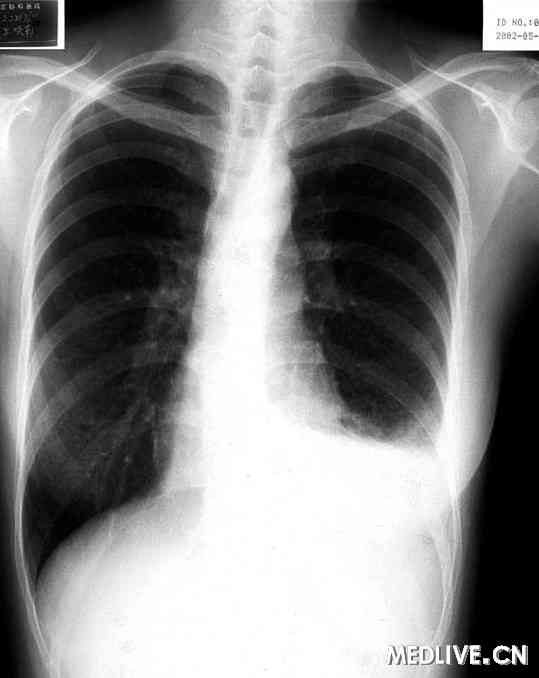 肺淋巴管肌瘤病 气胸 乳糜胸