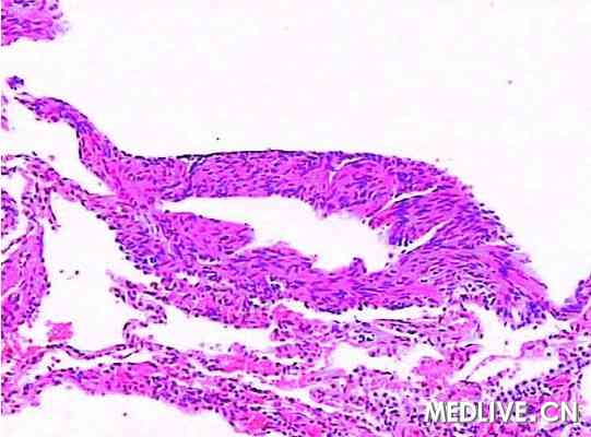 肺淋巴管肌瘤病 气胸 乳糜胸