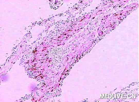 肺淋巴管肌瘤病 气胸 乳糜胸