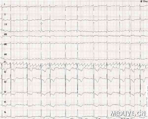 表现为纤维肌病的限制性心肌病 心电图检查
