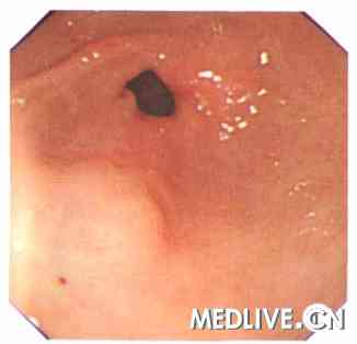  门诊胃镜示(图1)：胃窦大弯侧1．0cm×1．Ocm扁平隆起，表面黏膜光滑，考虑为黏膜下病变。