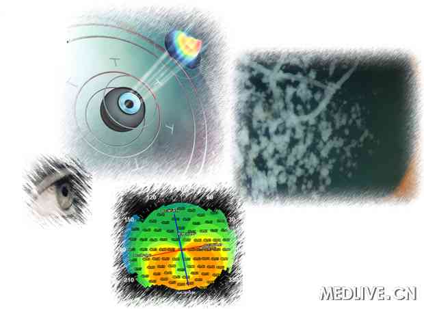 角膜移植手术（医脉通配图）