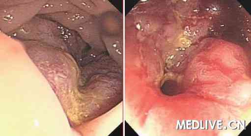 升结肠中段巨大肿物致肠腔明显狭窄