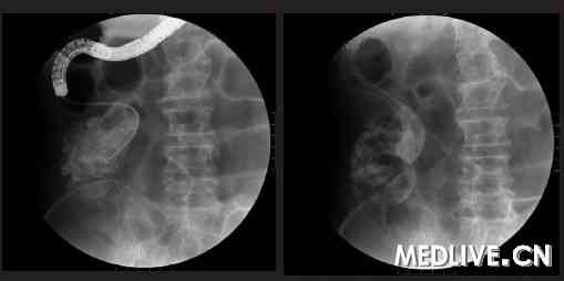 结肠镜下置入金属支架 结肠镜下置入金属支架