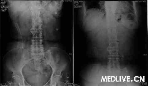 结肠支架置入后腹部平片 结肠支架置入后腹部平片