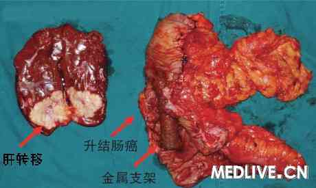 手术切除标本 手术切除标本