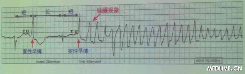 TdP 心电图