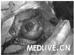 外伤性眼球脱臼