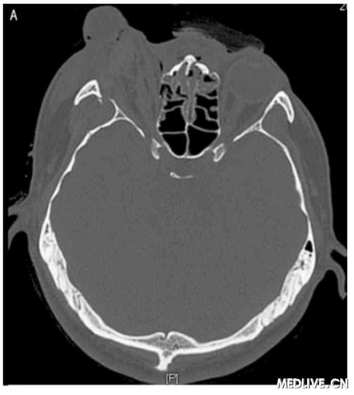 双眶三维CT 右侧眼球外突