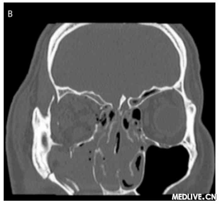 双眶三维CT 右眼眶下壁骨折