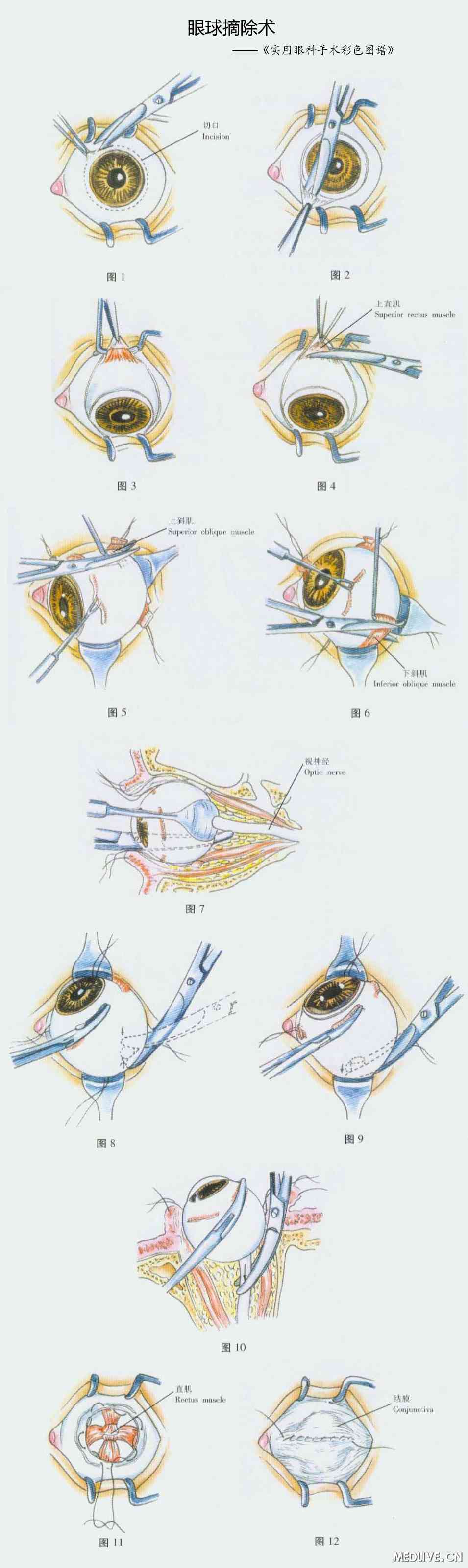 眼球摘除术&mdash;&mdash;《实用眼科手术彩色图谱》(高富军)