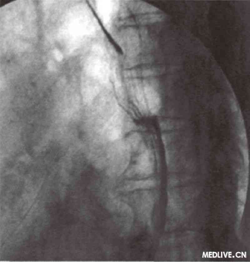 上消化道钡餐造影