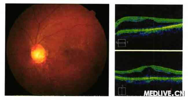 先天性视盘小凹的相干光断层扫描一例
