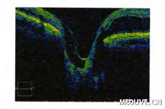 先天性视盘小凹的相干光断层扫描一例 先天性视盘小凹的相干光断层扫描一例