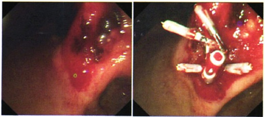 图2 胃镜示患者胃体溃疡伴搏动性出血,予钛夹止血