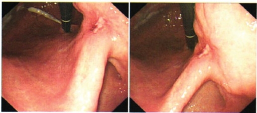 图3 胃镜示患者胃体下部溃疡H1期