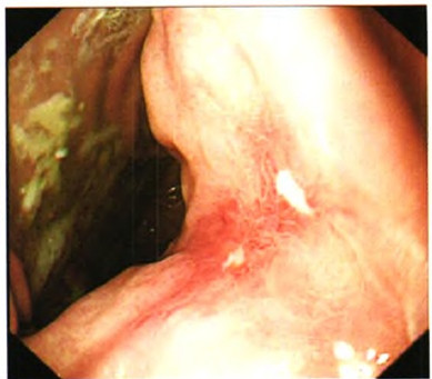 图4 胃镜示患者胃体溃疡较前明显变小变浅