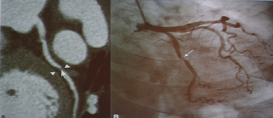图2-3 急性冠脉综合征