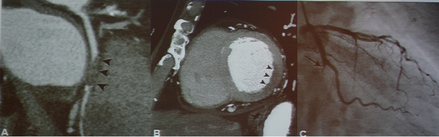 图2-3 急性冠脉综合征