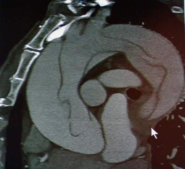 图8 主动脉夹层Stanford A