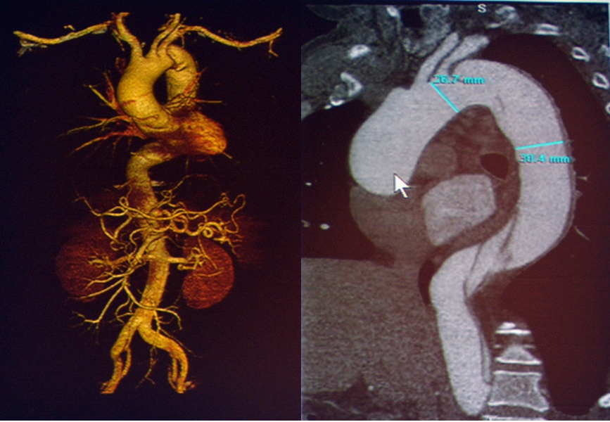 图9 主动脉夹层Stanford B