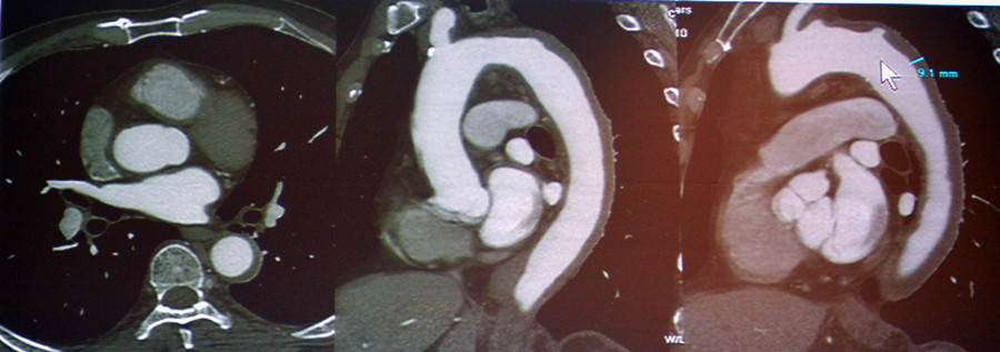 图10-11 壁间血肿