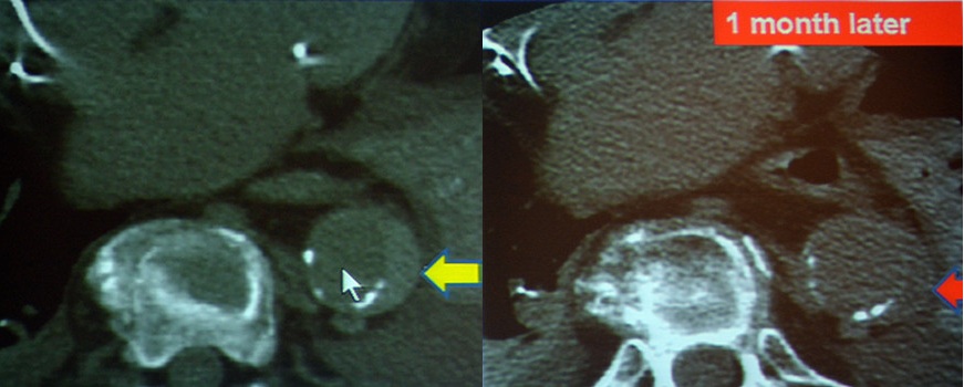 图10-11 壁间血肿