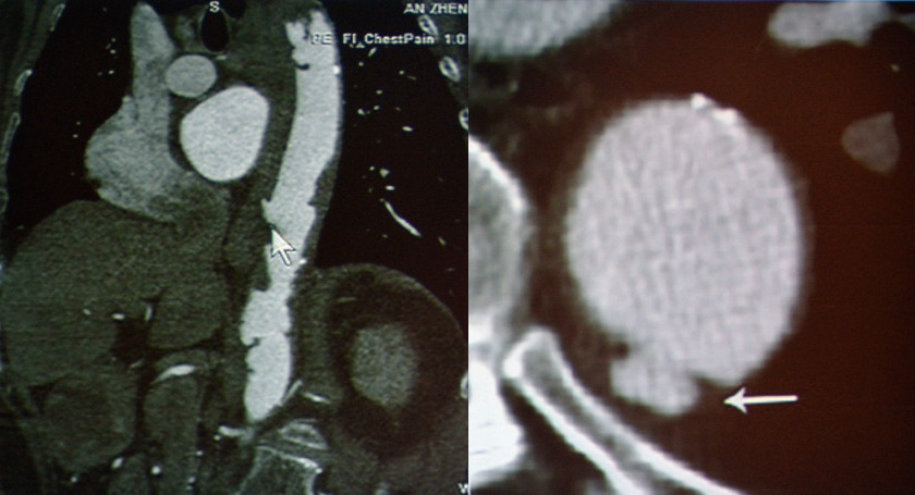 图12 穿透性溃疡