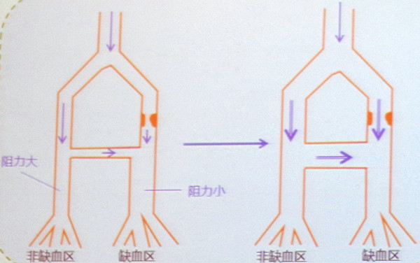 图3 中等剂量硝酸酯增加缺血区血液灌注