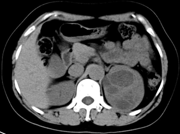 女，42岁，查体发现左肾占位（答案公布）