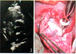 右心房血管肉瘤1例