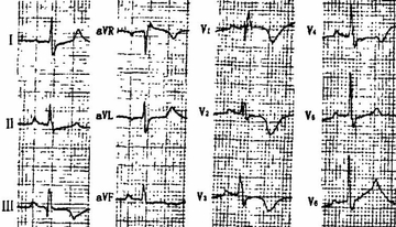 55岁急性胸痛患者，这个心电图提示什么？