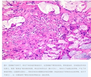 你的丰胸材料，正在你体内“慢性杀人”！21年病例揭开触目惊心的真相