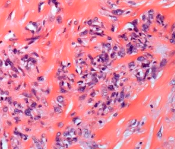 低级别中心型骨肉瘤的研究进展