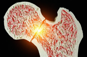 拇趾腓侧籽骨骨折一例