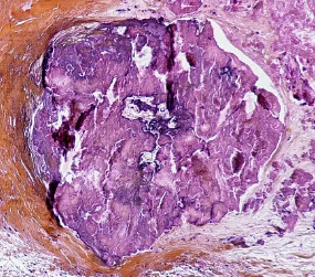 豚鼠耳炎诺卡菌骨髓炎感染1例