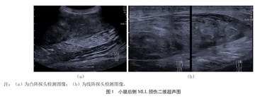 超声诊断左小腿Morel-Lavallée损伤合并静脉压迫1例