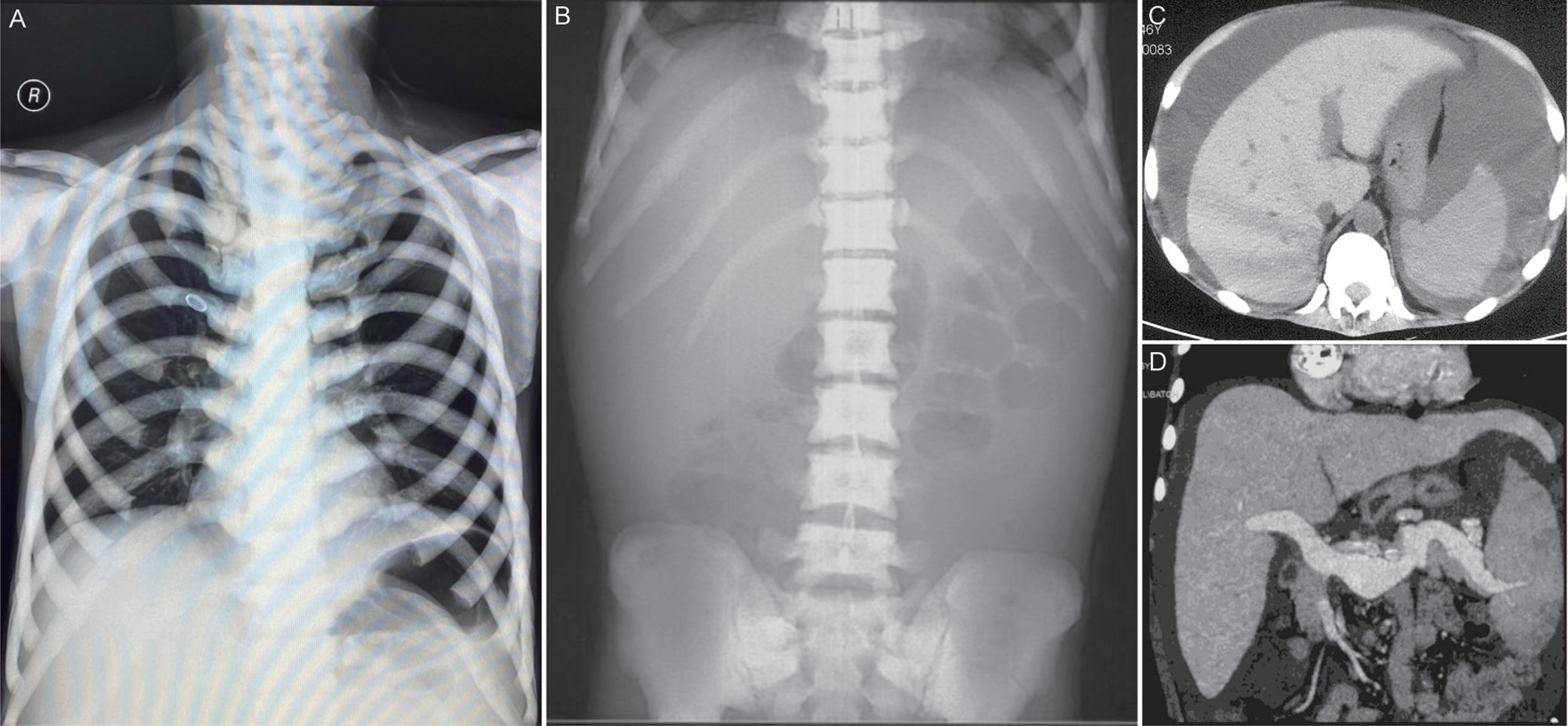 图1-Portal Hypertension Refractory Ascites Caused by Secondary Hemochromatosis.png