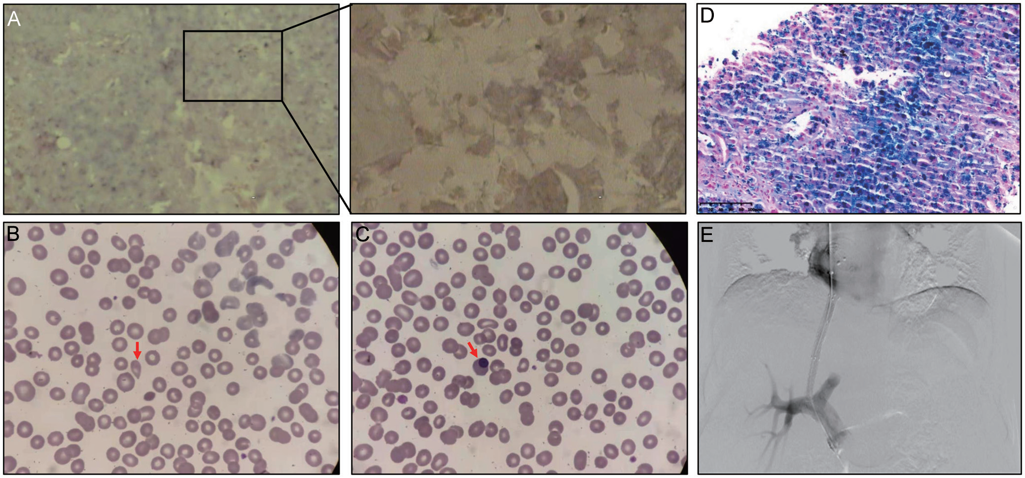 图2-Portal Hypertension Refractory Ascites Caused by Secondary Hemochromatosis.png