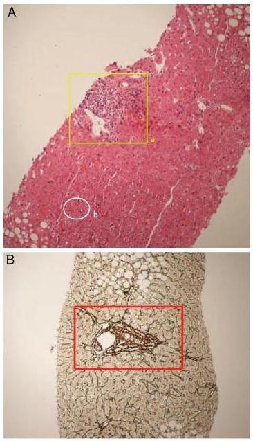 图1-CLINICAL CURE OF A CHRONIC HEPATITIS B PATIENT WITH NORMAL SERUM ALANINE AMINOTRANSFERASE TREATED WITH PEGYLATED INTERFERON ALFA-2A A CASE REPORT_02.jpg