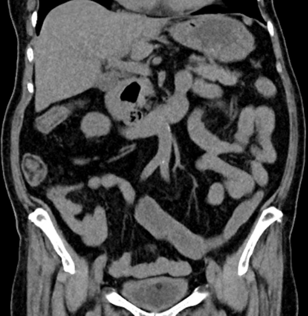 图A-A Rare Cause of Cholestatic Liver Enzyme Elevation from a Common Entity.png