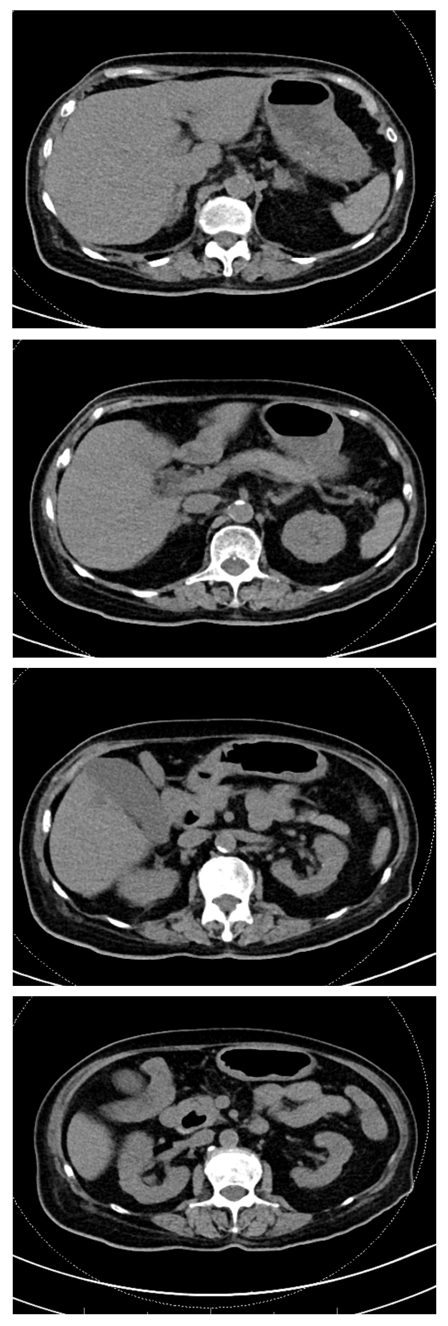 图B-A Rare Cause of Cholestatic Liver Enzyme Elevation from a Common Entity.png