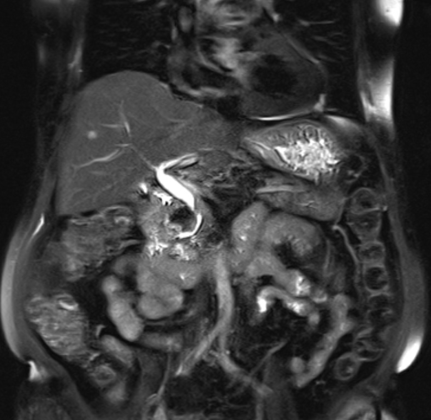 图C-A Rare Cause of Cholestatic Liver Enzyme Elevation from a Common Entity.png