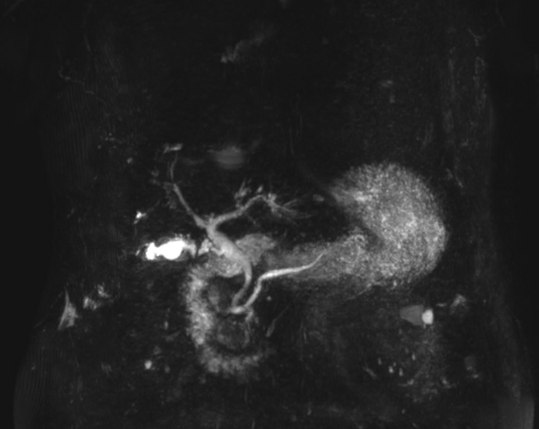 图D-A Rare Cause of Cholestatic Liver Enzyme Elevation from a Common Entity.png