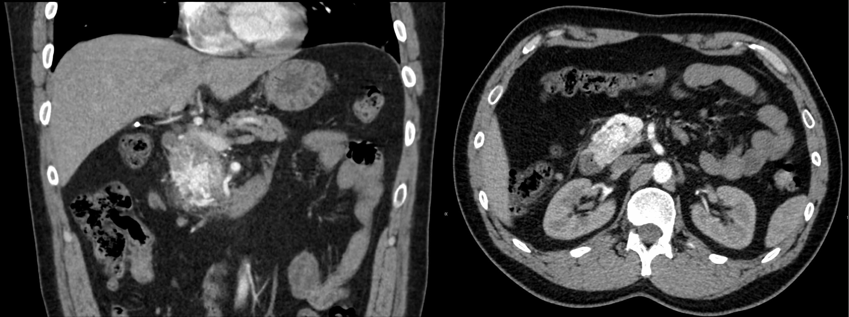 图3-An Unusual Cause of Acute Pancreatitis.png